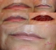 Krekta źle wykonanego makijażu permanentnego ust Boroń