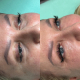 Rewitalizacja skóry pod oczami za pomocą stymulatorów egzosomów kolagenu